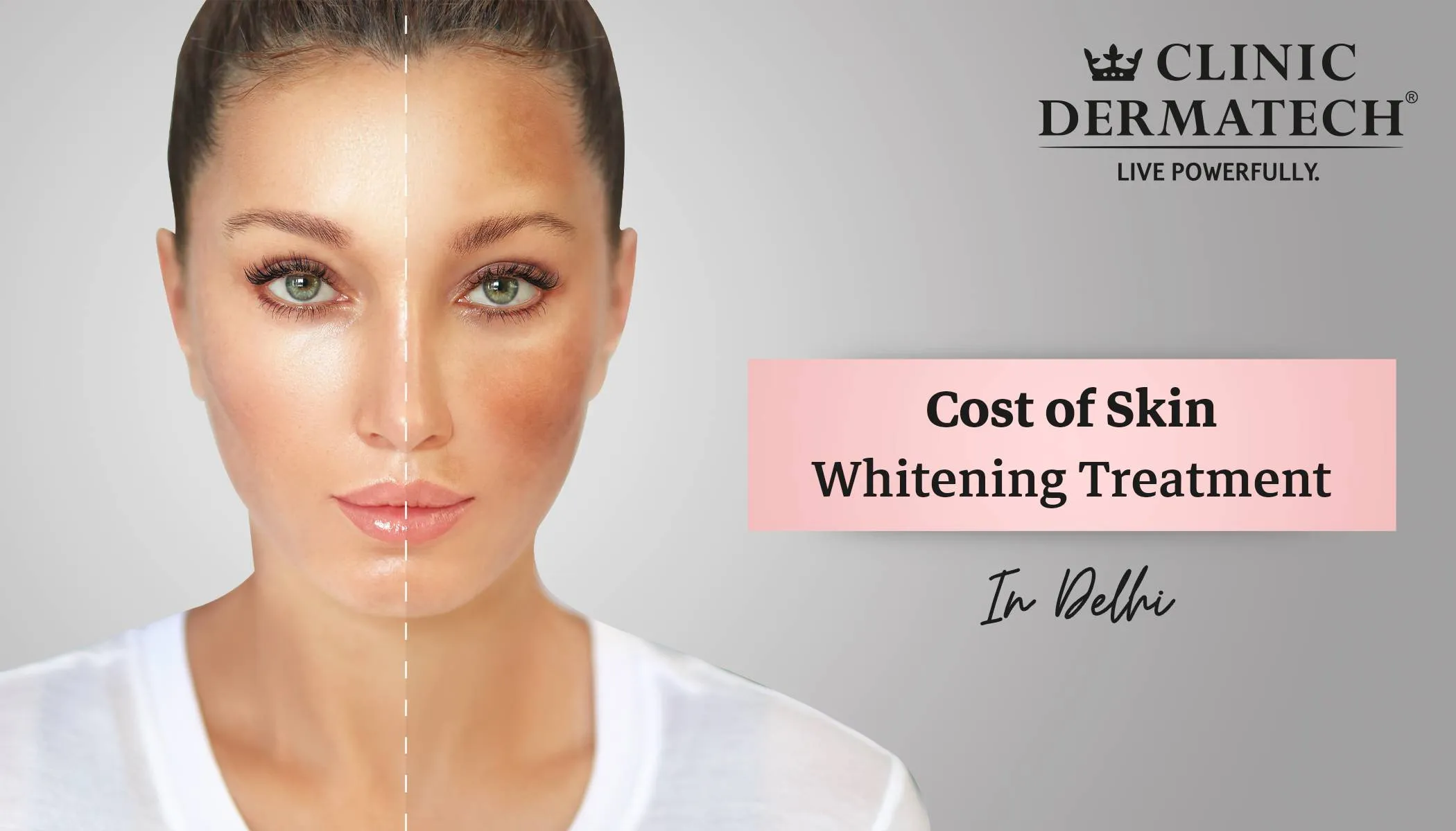 28715 in office teeth whitening delhi