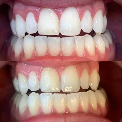 28722 teeth whitening meridian id 3