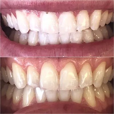 28722 teeth whitening meridian id 4