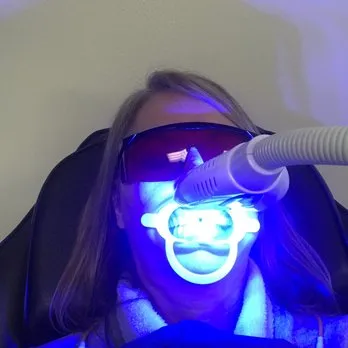 28722 teeth whitening meridian id 5