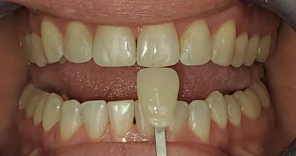 28737 teeth whitening aftercare