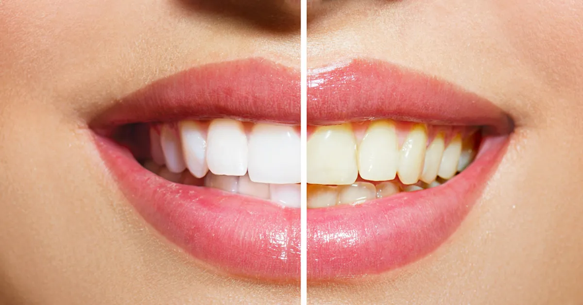 /img/28742-affordable-teeth-whitening.webp