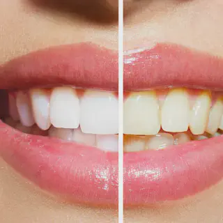 /img/28742-affordable-teeth-whitening.webp