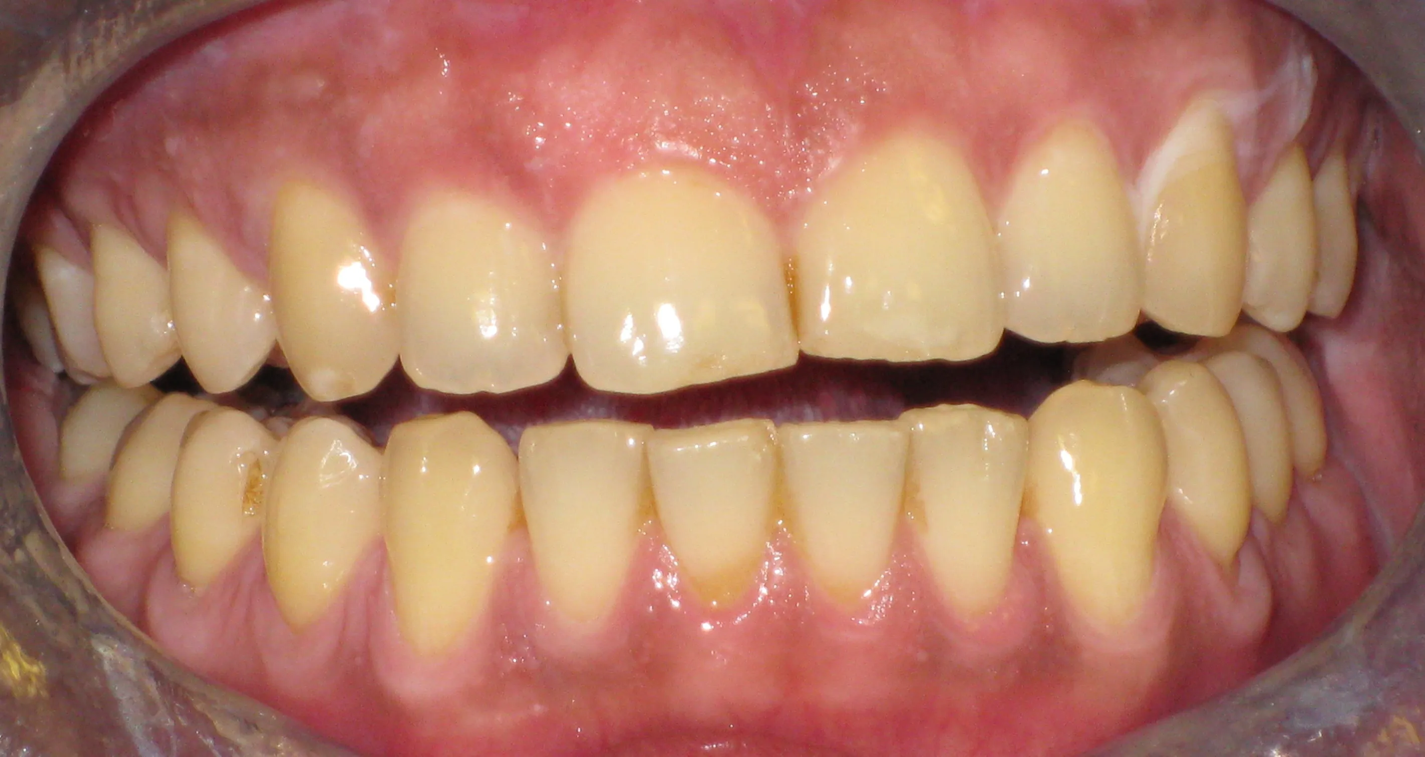 28746 at home teeth whitening