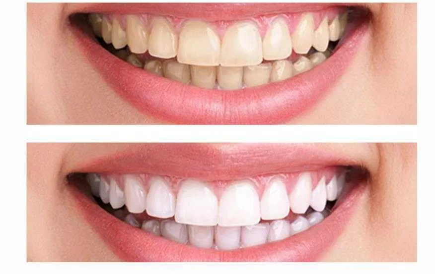 28746 in office teeth whitening