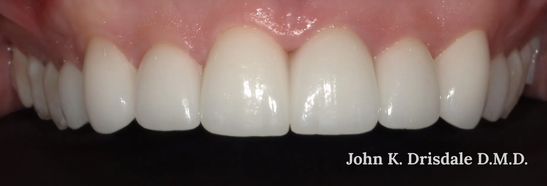 28750 types of teeth whitening midland mi