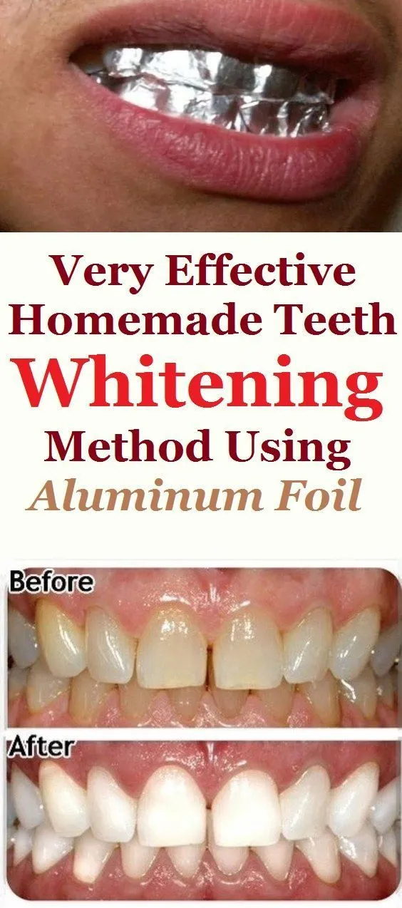 28753 teeth whitening before after