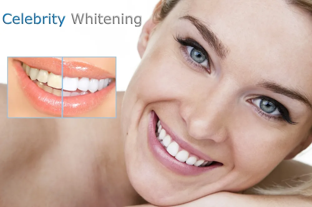 28753 whitening strips