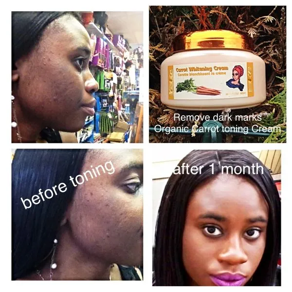 28758 hyperpigmentation treatment